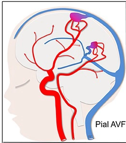 Rò động - tĩnh mạch não thai nhi (Cerebral Arteriovenous Fistula - AVF)