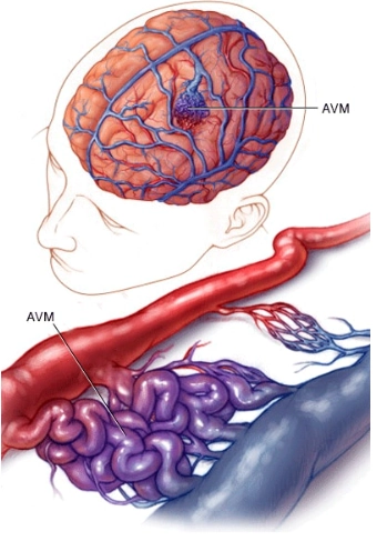 Dị dạng thông Động-Tĩnh mạch não (Brain Arteriovenous Malformation - AVM) 