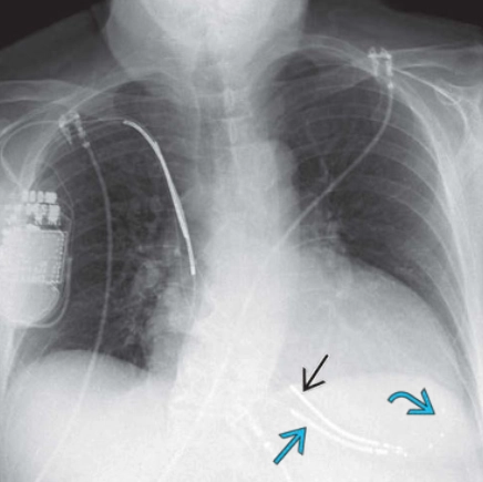 Ghép tim (Heart transplantation)