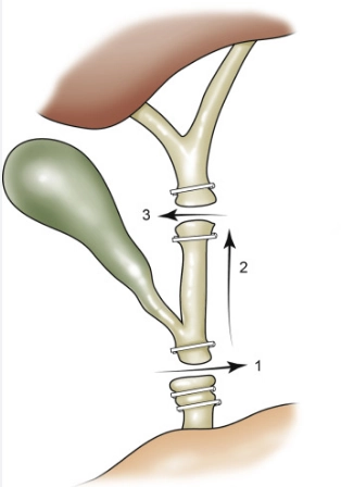 Tổn thương đường mật (Bile Duct Injuries - BDI)