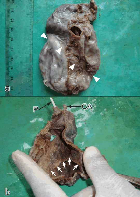 Túi mật có vách ngăn (Septate Gallbladder)