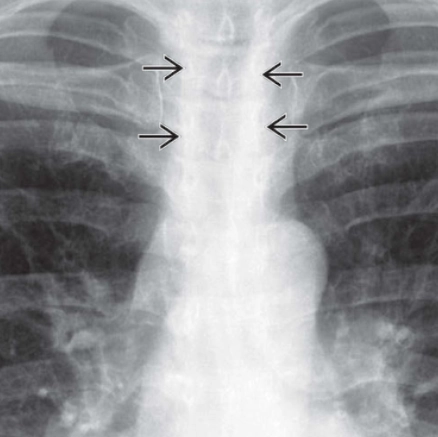 Nhiễm amyloid khí phế quản (Tracheobronchial Amyloidosis)