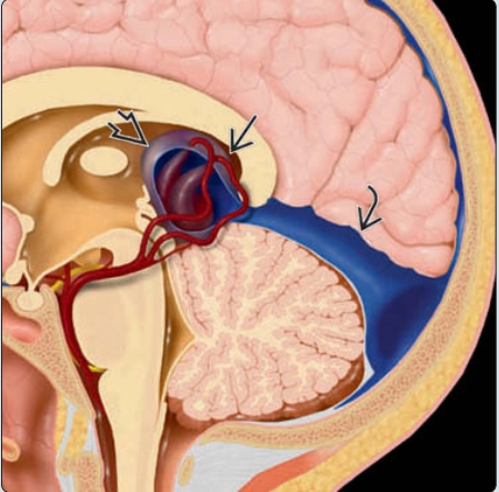 Phình tĩnh mạch Galen ở thai nhi