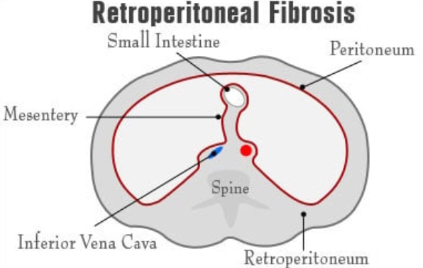 Xơ hóa sau phúc mạc (Retroperitoneal fibrosis - RPF)