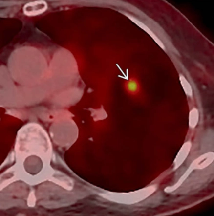 Viêm phổi do nấm Cryptococcus (Pulmonary cryptococcosis)