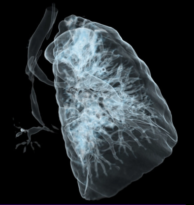 Biến thể phế quản thực quản (Esophageal bronchus)