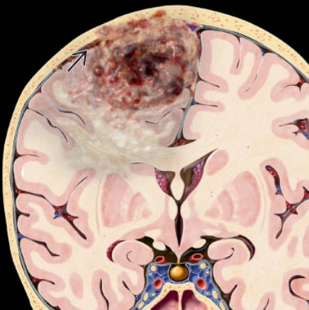 U thần kinh đệm lan tỏa toàn não (kiểu hình tăng trưởng) (Gliomatosis Cerebri- GC): 