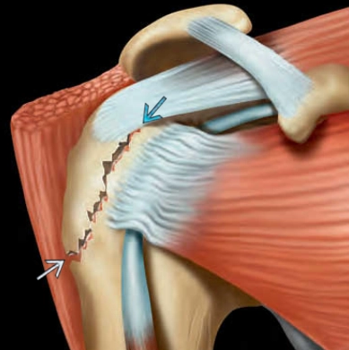 Gãy mấu động lớn xương cánh tay (Greater tubercle fracture of the shoulder)