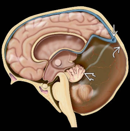 DỊ TẬT DANDY-WALKER (DANDY-WALKER CONTINUUM)