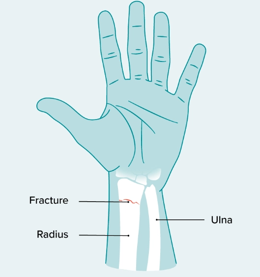 Gãy đầu dưới xương quay (Distal radial fracture)