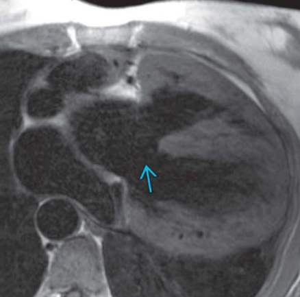 Thông liên thất (Ventricular Septal Defect - VSD) 