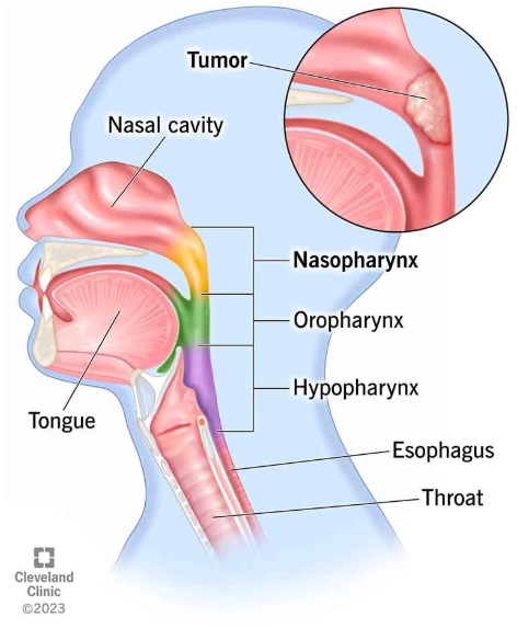 Ung thư biểu mô vòm họng (Nasopharyngeal carcinomas - NPC)