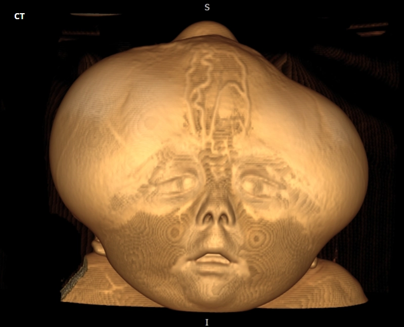 Bất thường Vòm sọ (Abnormal Calvarium)