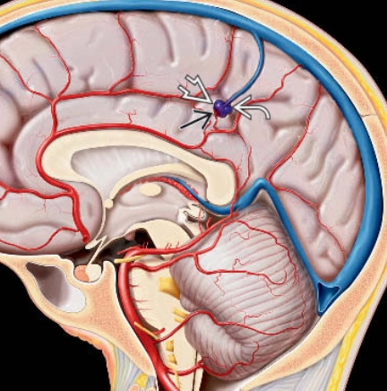 Dò động-tĩnh mạch màng mềm (Pial Arteriovenous Fistula - pAVF)