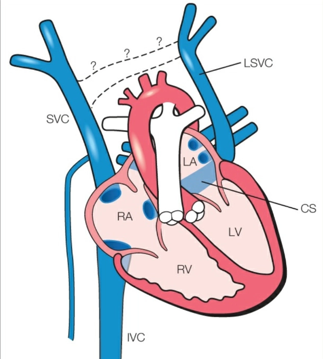Tồn tại tĩnh mạch chủ trên trái (LSVC)
