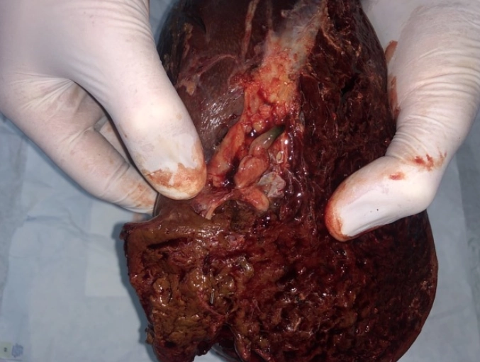 U nhú trong ống mật (Intraductal Papillary Neoplasm of the Bile Duct - IPNB) 