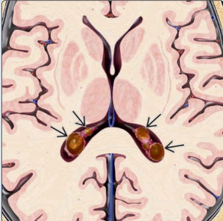 Nang đám rối mạch mạc thai nhi (Choroid Plexus Cyst)