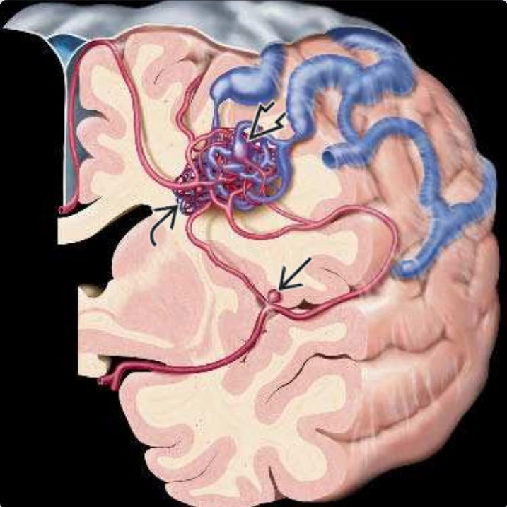 Xuất huyết não &amp; dị dạng mạch máu (Intracranial hemorrhage &amp; vascular malformations)