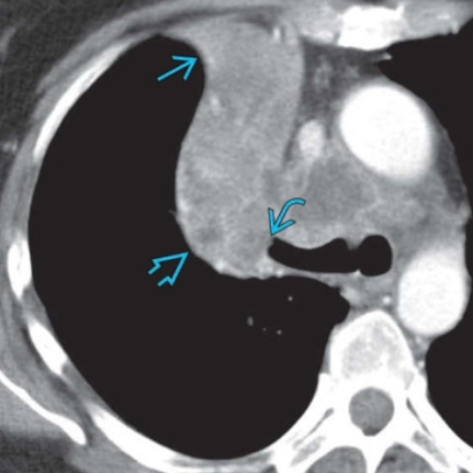 Xẹp phổi (tổng quan) - Lung atelectasis