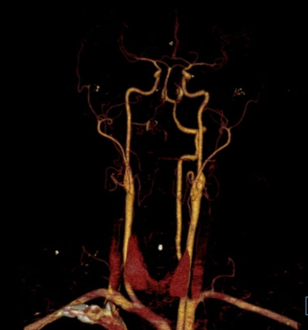 Tổn thương mạch máu não-cổ do chấn thương kín (Blunt Cerebrovascular Injury - BCVI)