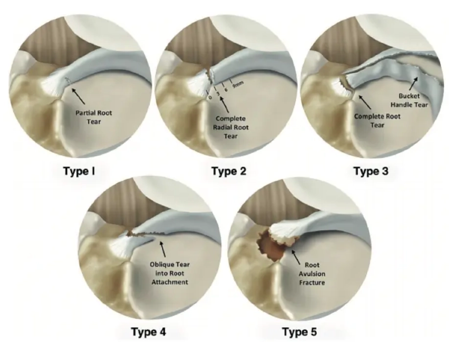 Rách rễ sụn chêm (Meniscal root tear)