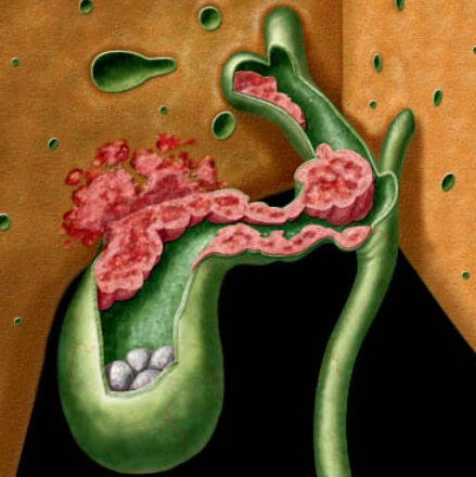 Ung thư túi mật (Gallbladder Carcinoma)