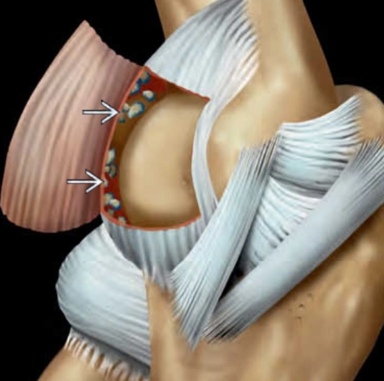  Mảnh vỡ trong khớp khuỷu (Intraarticular Bodies, Elbow)
