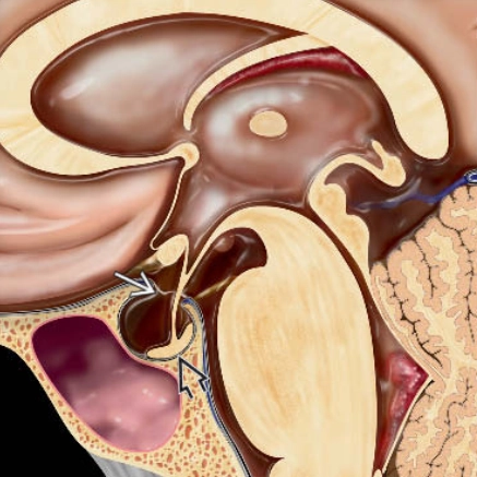 Hội chứng Hố yên rỗng (Empty sella)