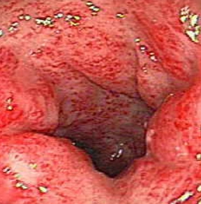 Viêm ruột do xạ trị  (Radiation-induced enteritis)