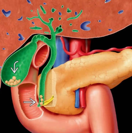Sỏi ống mật chủ (Choledocholithiasis - CBD)