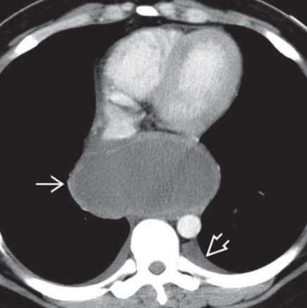 Nang phổi (Pulmonary Cyst)