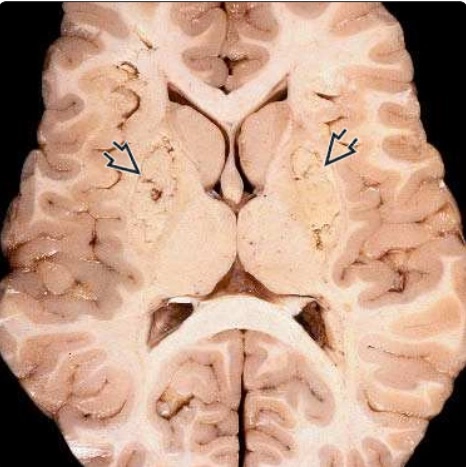 Bệnh lý chuyển hóa và ngộ độc não (Toxic / metabolic disorders)