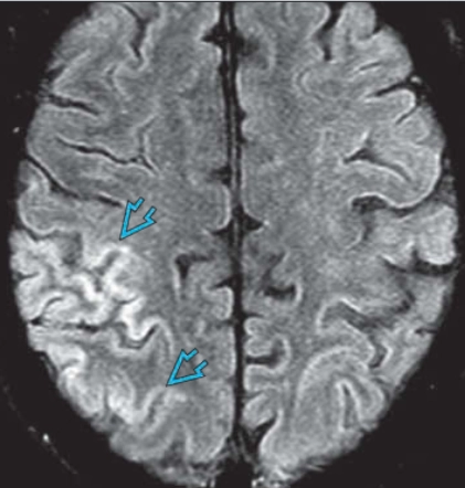 Động kinh (Status Epilepticus- SE)