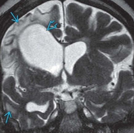 Suy giảm chức năng tiểu não đối bên (Crossed Cerebellar Diaschisis- CCD)