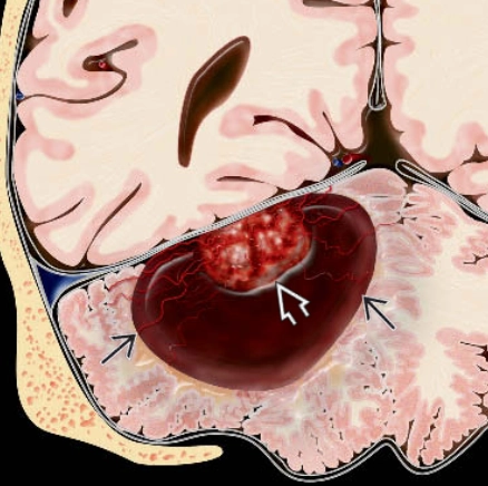 U nguyên bào mạch máu hệ thần kinh trung ương - Hemangioblastoma (central nervous system)