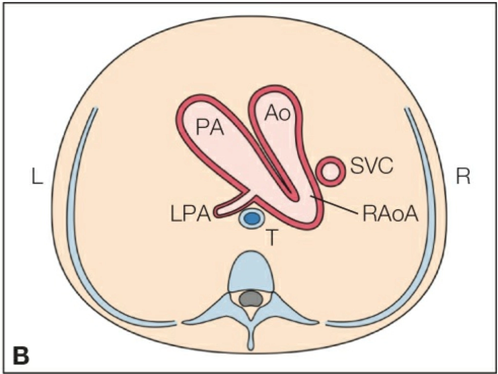 Cung động mạch chủ bên phải với ống động mạch bên phải