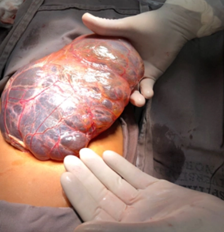 Nang mạc treo (Mesenteric cyst)