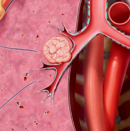 U Carcinoid phế quản (Bronchial Carcinoid Tumors)/ U thần kinh nội tiết phế quản