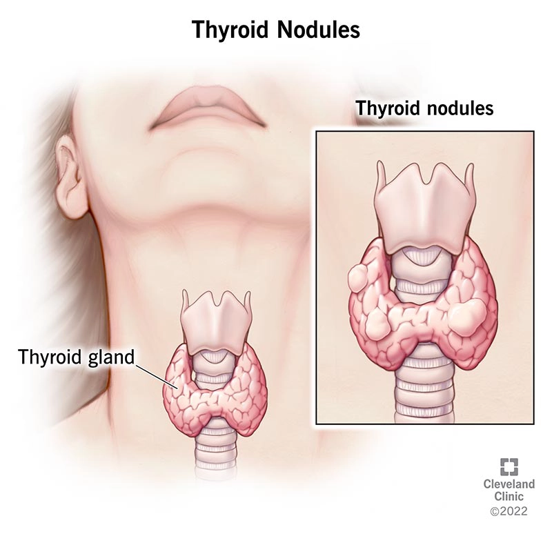 Nang keo tuyến giáp (Colloid nodule thyroid)