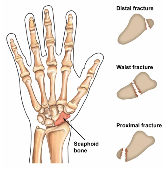  Gãy xương thuyền (Scaphoid Fracture)