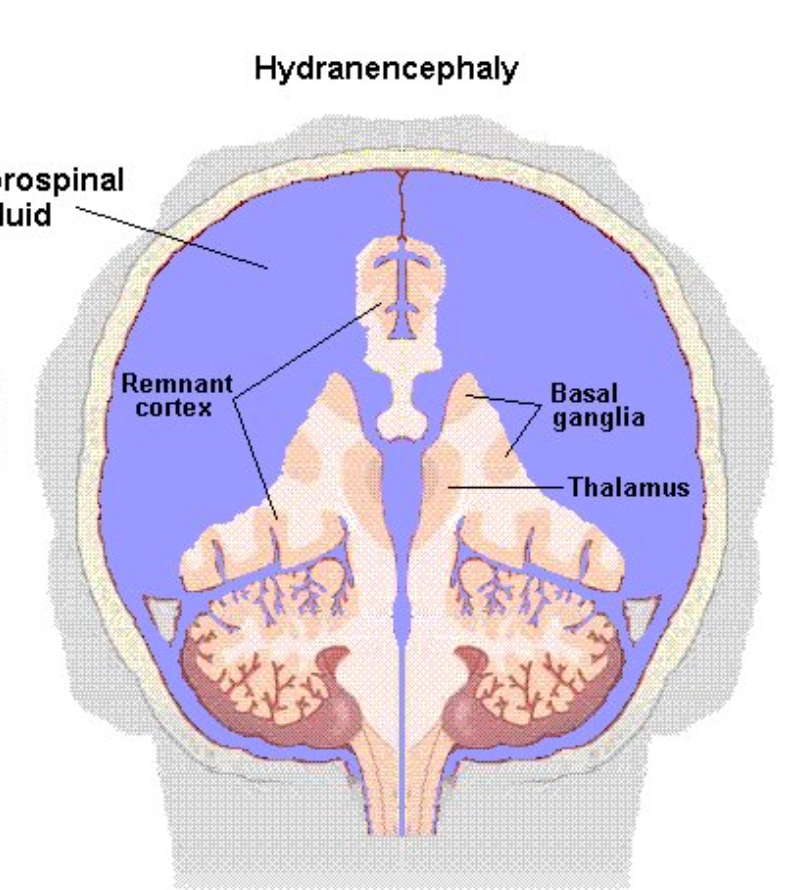 Não thoái hóa nước thai nhi (Hydranencephaly)