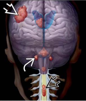 U màng não thất (Ependymoma- EPN)