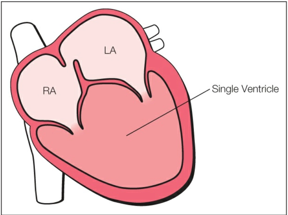 Thất hai đường vào (Double inlet ventricle)