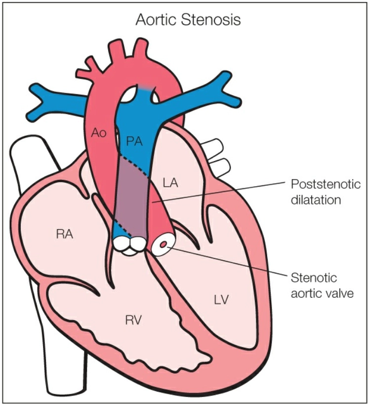Hẹp van động mạch chủ