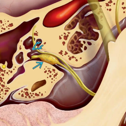 U bao dây thần kinh tiền đình (Vestibular schwannoma - VS)