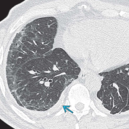 Tổn thương dạng lưới (Reticular pattern)