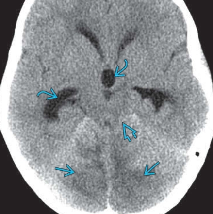 Viêm tiểu não cấp (Acute cerebellitis)