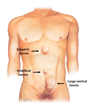 Thoát vị vết mổ (Incisional Hernia)