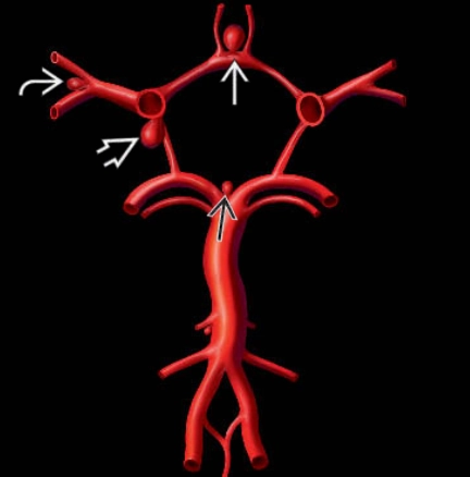 Phình mạch não dạng túi (Saccular cerebral aneurysm)