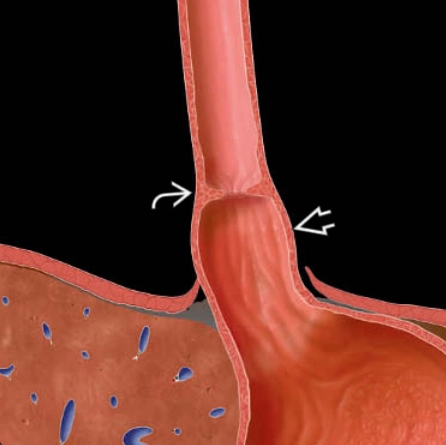 VÒNG SCHATZKI (Schatzki Ring)